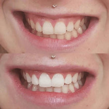 Load image into Gallery viewer, Special Offer - SNOW Teeth Whitening™ System