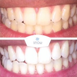 SNOW TEETH WHITENING™ ZAHNWEISS-SYSTEM FÜR ZUHAUSE [ALL-IN-ONE KIT]