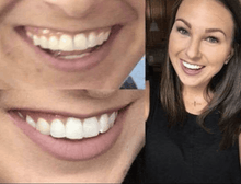 Load image into Gallery viewer, GRONK&#39;s Snow® Teeth Whitening At-Home System [All-in-One Kit]
