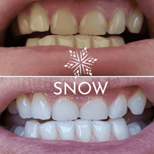 Load image into Gallery viewer, Snow® Teeth Whitening At-Home System [All-in-One Kit] - 15% OFF
