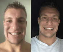 Load image into Gallery viewer, SNOW TEETH WHITENING™ ZAHNWEISS-SYSTEM FÜR ZUHAUSE [ALL-IN-ONE KIT]
