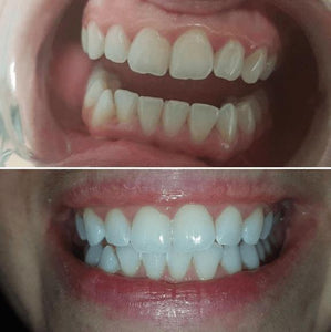 SISTEMA EM CASA SNOW TEETH WHITENING™ [‘KIT’ COMPLETO]