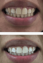 Load image into Gallery viewer, SNOW TEETH WHITENING™ ZAHNWEISS-SYSTEM FÜR ZUHAUSE [ALL-IN-ONE KIT]
