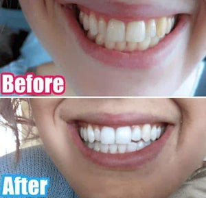 SISTEMA EM CASA SNOW TEETH WHITENING™ [‘KIT’ COMPLETO]