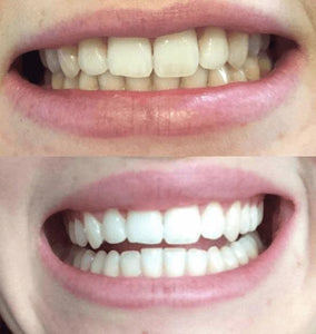 SISTEMA EM CASA SNOW TEETH WHITENING™ [‘KIT’ COMPLETO]