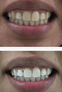 Special Offer - SNOW Teeth Whitening™ System