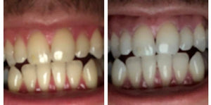 Special Offer - SNOW Teeth Whitening™ System