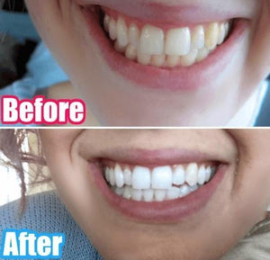 Special Offer - SNOW Teeth Whitening™ System